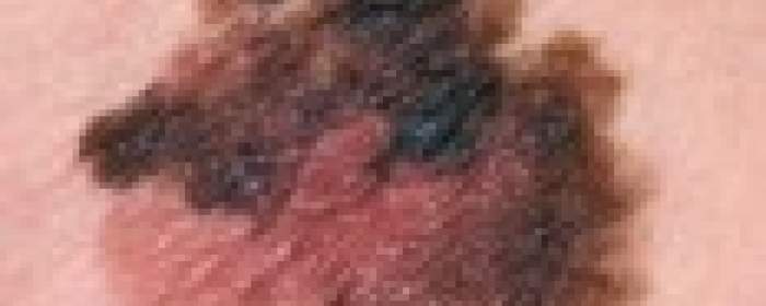 Malignes Melanom, 
(Quelle https://www.nhs.uk/conditions/melanoma-skin-cancer/)