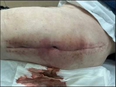Abb. 1: Sezernierende Fistel im Bereich einer Operationsnarbe. Bild: [Unfallchirurgie/UKGM Gießen].